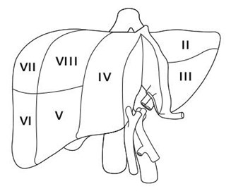 Segmental anatomy of the liver; the liver is being divided along the plane to be split and transplanted into small pediatric recipient and a larger (pediatric or adult) recipient (Scenarios 1 and 2 in the text).