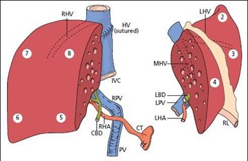 Split for 2 larger recipients (either adult or large pediatric patients); the difference from figure 1 is that segment 4 goes with segments 2 and 3 to give similar-sized grafts. This corresponds with Scenario 3 in the text. In this figure, Arabic numerals are used.